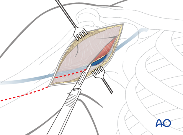 Exposure of the superficial fascia