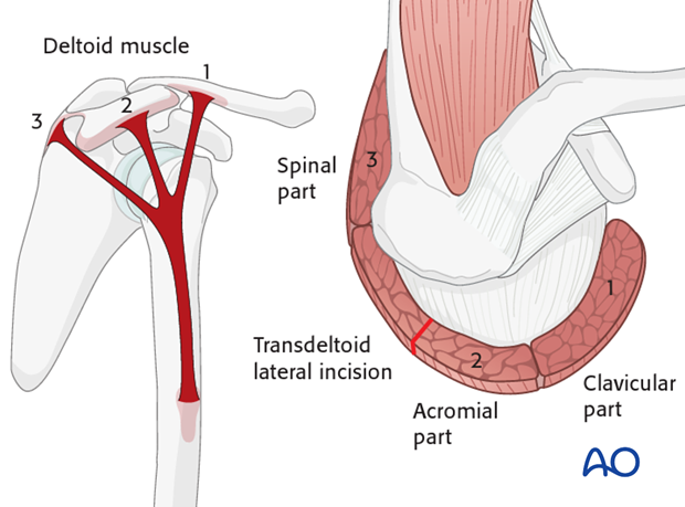 The incision is placed between the acromial part (2) and the spinal part (3) of the deltoid muscle