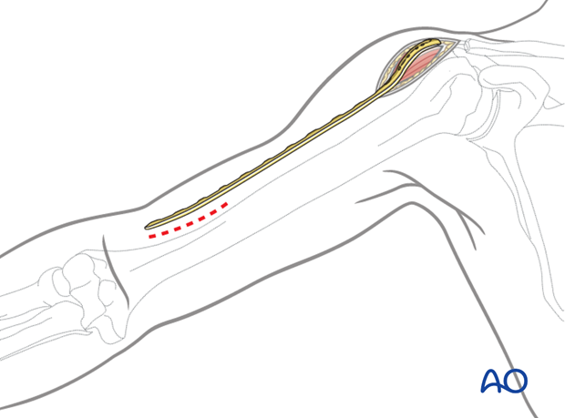 Distal incision