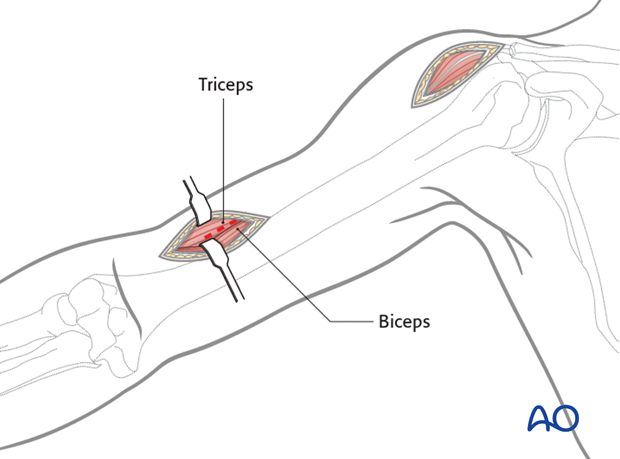 Distal incision