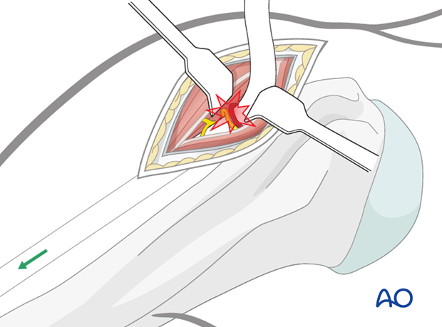 Take great care not to injure the axillary nerve and its accompanying vessels.