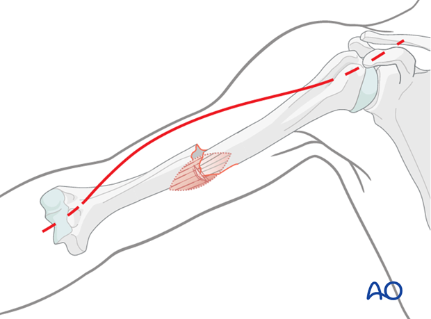 open fractures in the humeral shaft