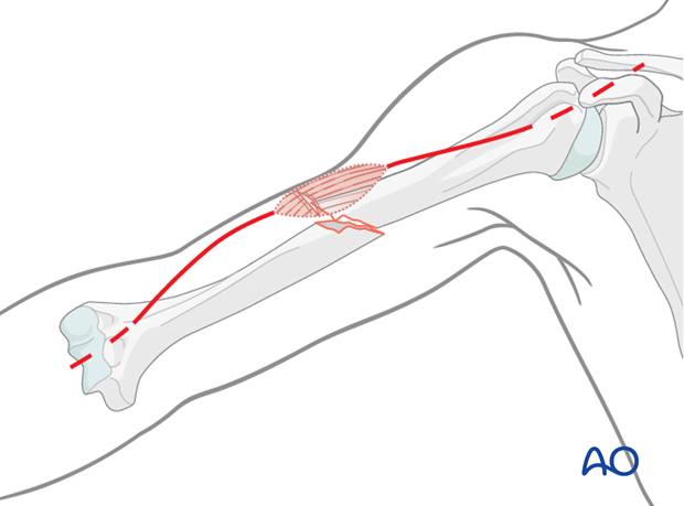 open fractures in the humeral shaft