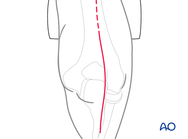 Skin incision for triceps-elevating approach