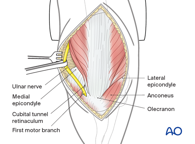 Ulnar nerve mobilization