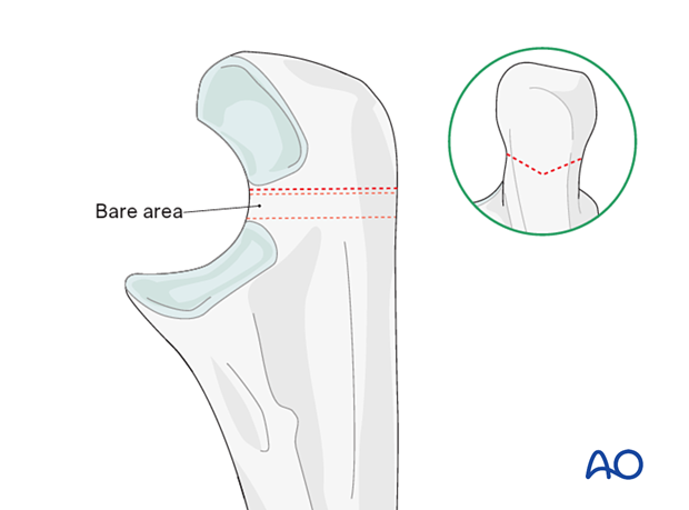 An olecranon osteotomy should aim for the bare area of the greater sigmoid notch to avoid cartilage damage.