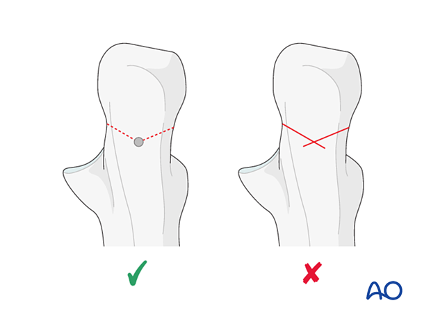 Drilling the apex of the chevron mark will prevent notching of the ulna during use of the saw and will prevent the risk of fracture propagation during osteotomy