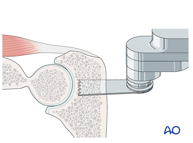 Using a fine oscillating saw to divide only up to three quarters of the depth of the bone