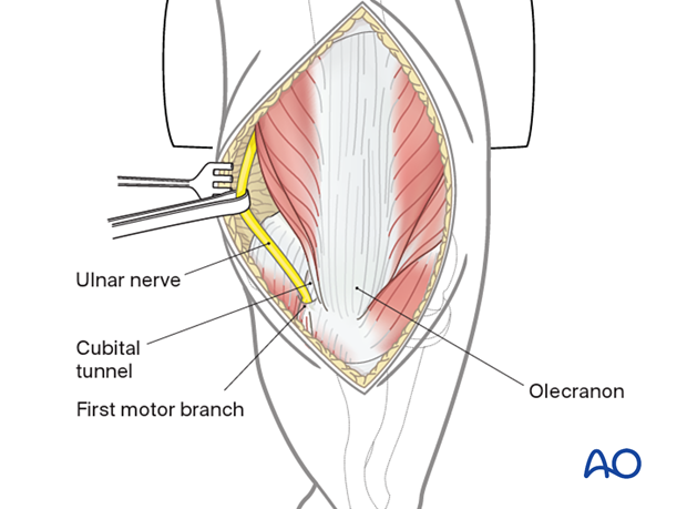 Ulnar nerve mobilization