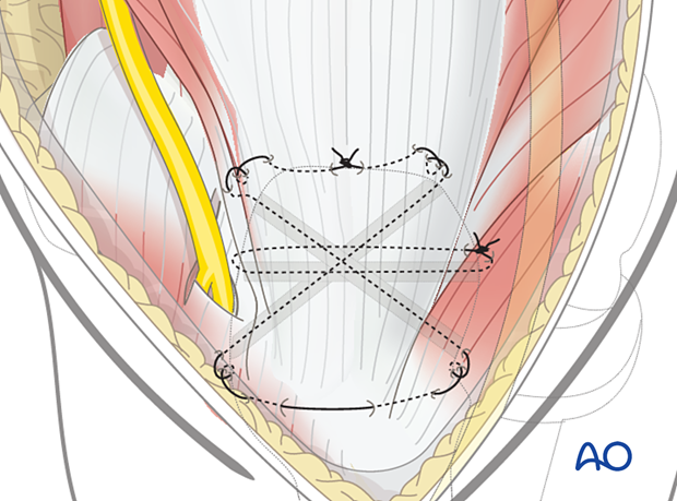 Reattachment of the triceps tendon insertion to the olecranon with transosseous sutures