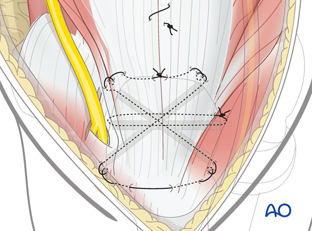 Final transosseous suture fixation