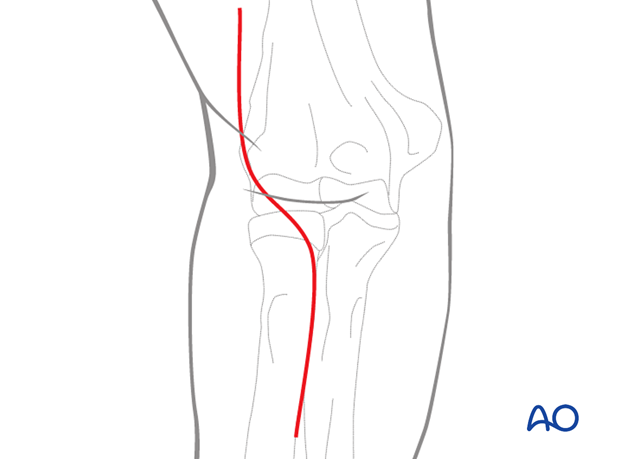 Skin incision for anterior approach to the capitellum