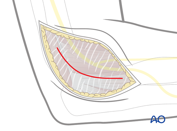 Lateral approach