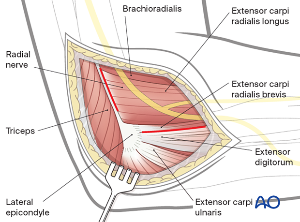 Lateral approach