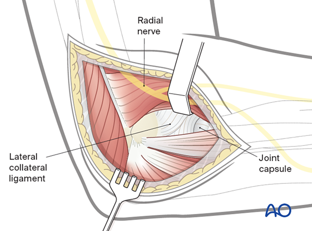 Lateral approach