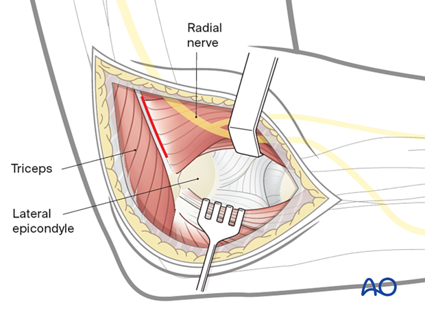 Lateral approach