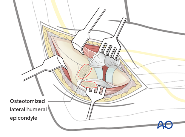 Lateral approach