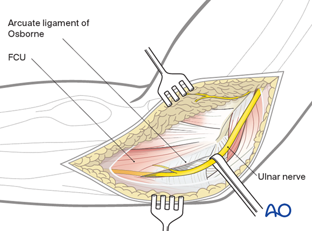 Gently free the ulnar nerve and protect it.