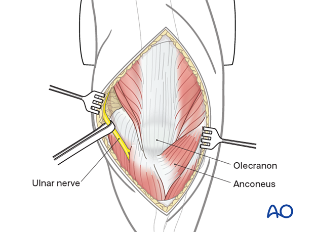 Lateral paraolecranon approach