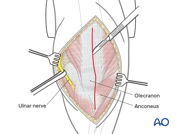 Lateral paraolecranon approach