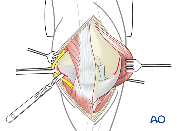 Lateral paraolecranon approach