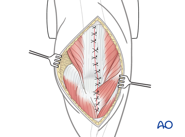 Lateral paraolecranon approach