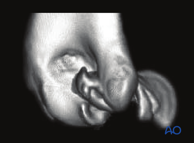 3-D CT reconstruction of a trochlear fracture