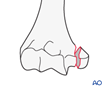 distal humerus