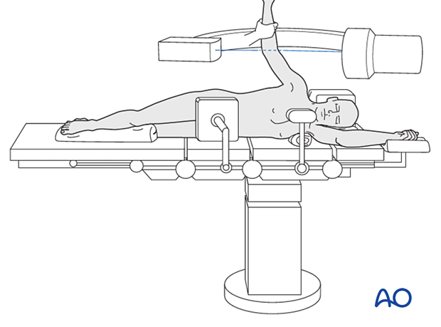 C-arm positioning for AP images with the patient in lateral decubitus position