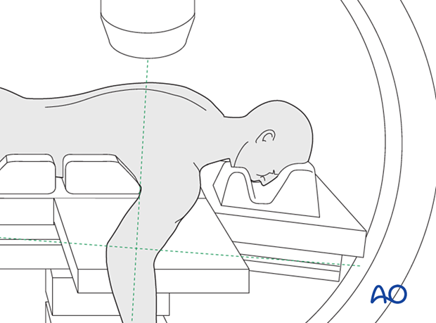 C-arm positioning with the patient prone