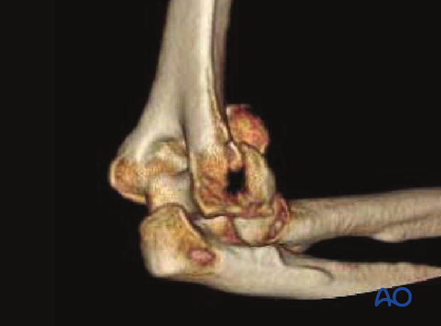 3-D CT reconstruction of a complex coronal fracture of capitellum and trochlea, involving a lateral epicondylar fracture, posterior impaction, and medial fracture extension