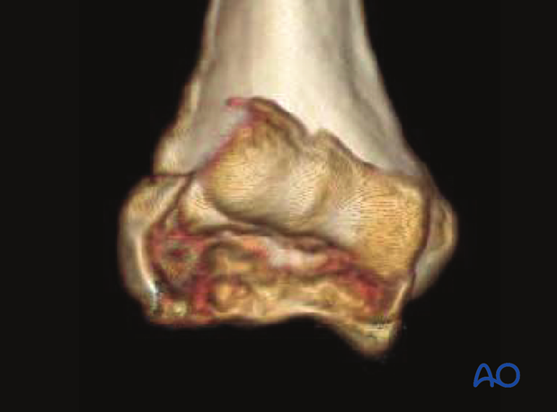 3-D CT reconstruction of a complex coronal fracture of capitellum and trochlea, involving a lateral epicondylar fracture, posterior impaction, and medial fracture extension