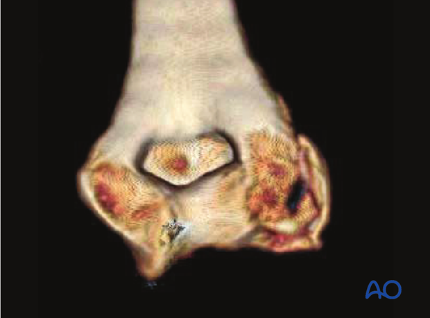 3-D CT reconstruction of a complex coronal fracture of capitellum and trochlea, involving a lateral epicondylar fracture, posterior impaction, and medial fracture extension