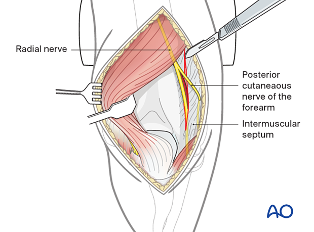 To reduce the risk of radial nerve stretching during fracture exposure, the lateral intermuscular septum may need to be incised.