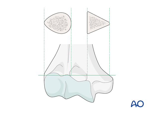 Cross-section shapes of lateral and medial column