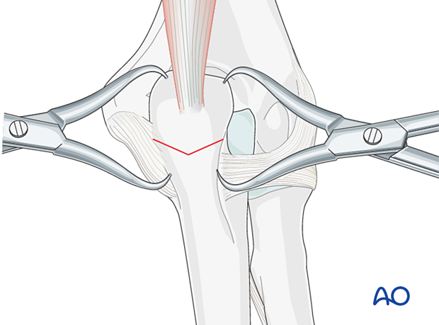 Reduce and hold the osteotomy with pointed reduction forceps to apply compression.