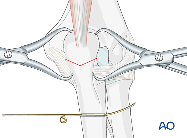 Insert the shorter segment of the wire through the drilled hole from medial to lateral.