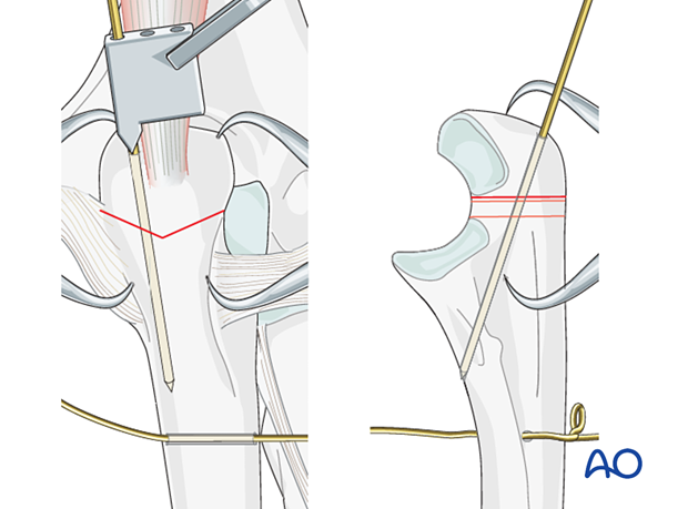 Insertion of K-wires for tension band wiring