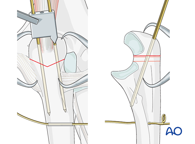 Insertion of K-wires for tension band wiring