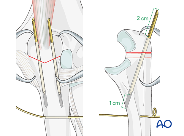 Insertion of K-wires for tension band wiring