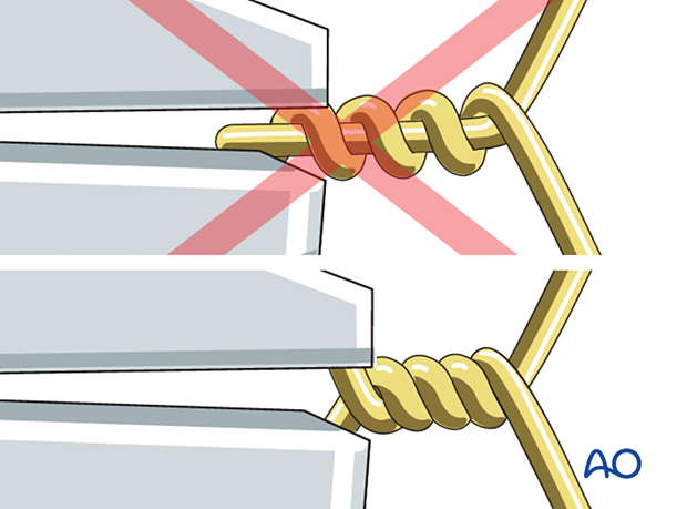 Tightening the tension band wire