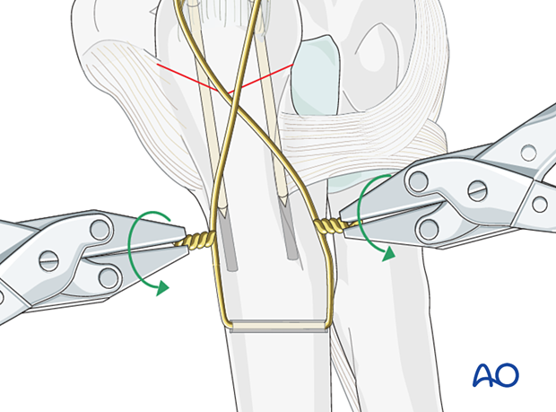 Tightening the tension band wire