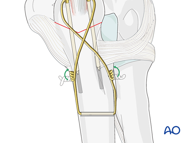 Turn both wire ends towards the ulna/olecranon not to irritate the soft tissues later.