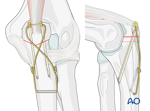 Tension band fixation of olecranon osteotomy