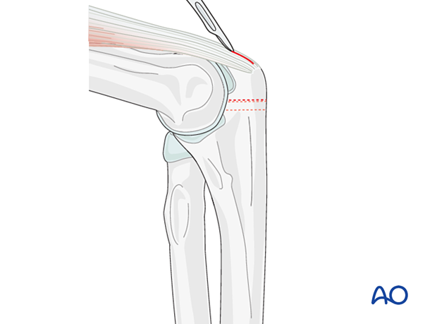 Incision of triceps tendon