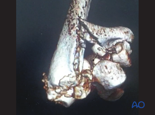 3-D CT reconstruction showing a multifragmentary distal humeral fracture