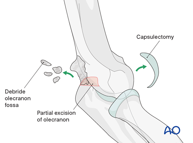 Capsulectomy and debridement of the olecranon tip and olecranon fossa