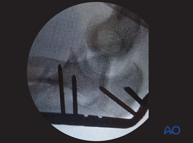 approach to the le fort i level of the midface in cleft lip and palate patients