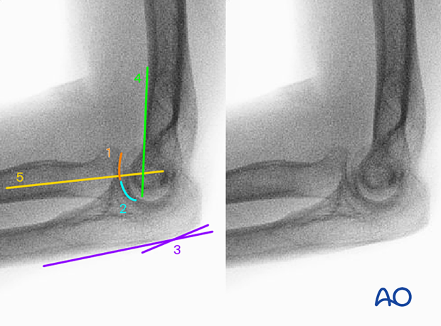 Anatomical lines and landmarks in the lateral view