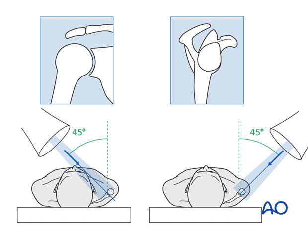 Clinical and radiological examination of patients with scapular injuries